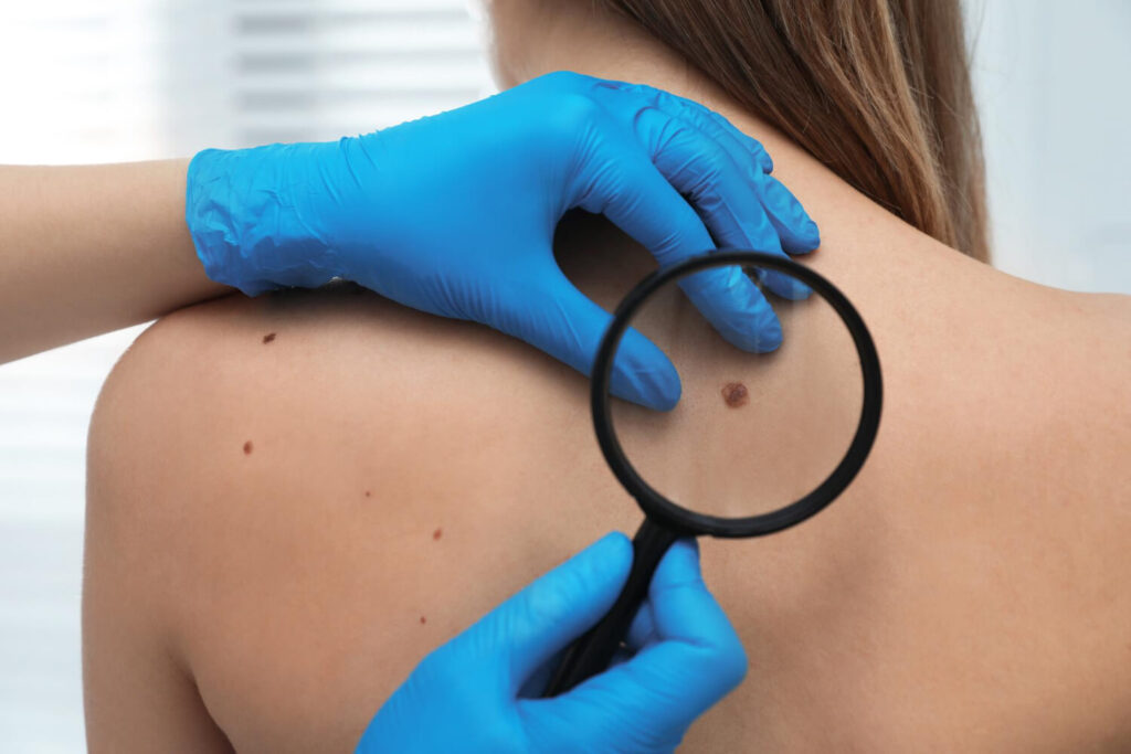 Examen dermatologique d'un grain de beauté avec bouton - consultation médicale