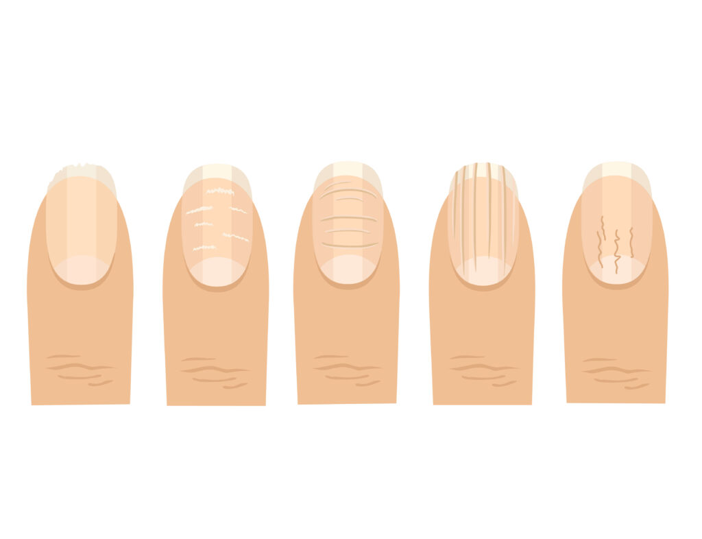 Ongles déformés en forme de vagues : quelles sont les causes ? 2 Gros plan sur un ongle déformé avec des vagues ou des stries, illustrant les causes médicales possibles.