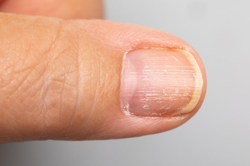 Ongles déformés en forme de vagues : quelles sont les causes ? 3 ongle déformé en forme de vagues