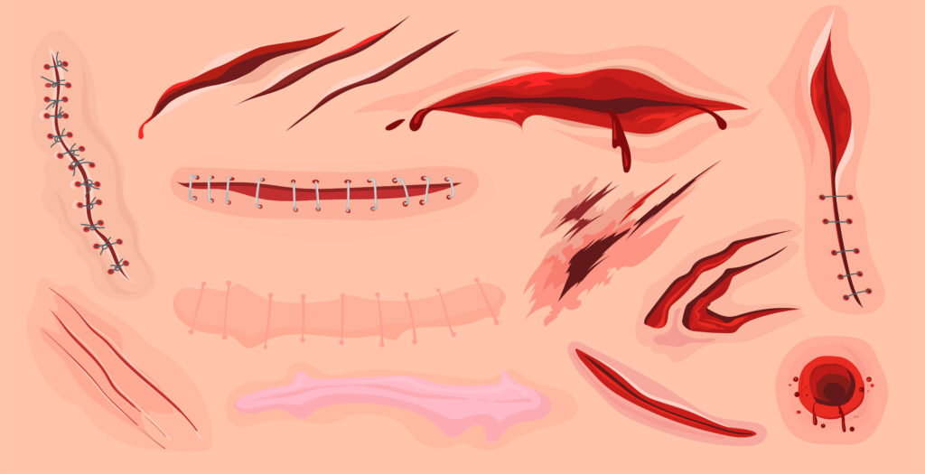 Cicatrice de circoncision et bourrelet : est-ce normal ? 1 Cicatrice de circoncision et bourrelet : est-ce normal ?