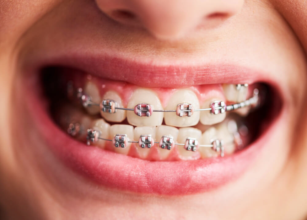 Appareil lingual insupportable : est-ce normal et que faire ? 2 Gros plan sur la face interne des dents montrant un appareil orthodontique lingual avec ses brackets.