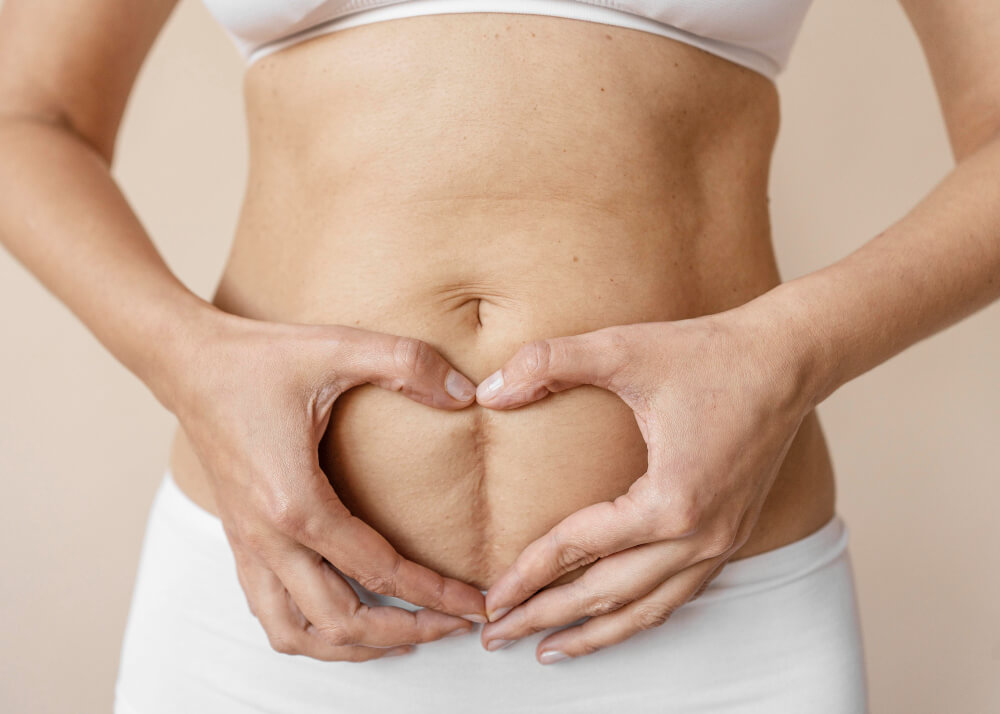 Douleur au nombril 1 mois après une cœlioscopie : est-ce normal ? 7 Gros plan sur une cicatrice de cœlioscopie au niveau du nombril, un mois après l'opération.