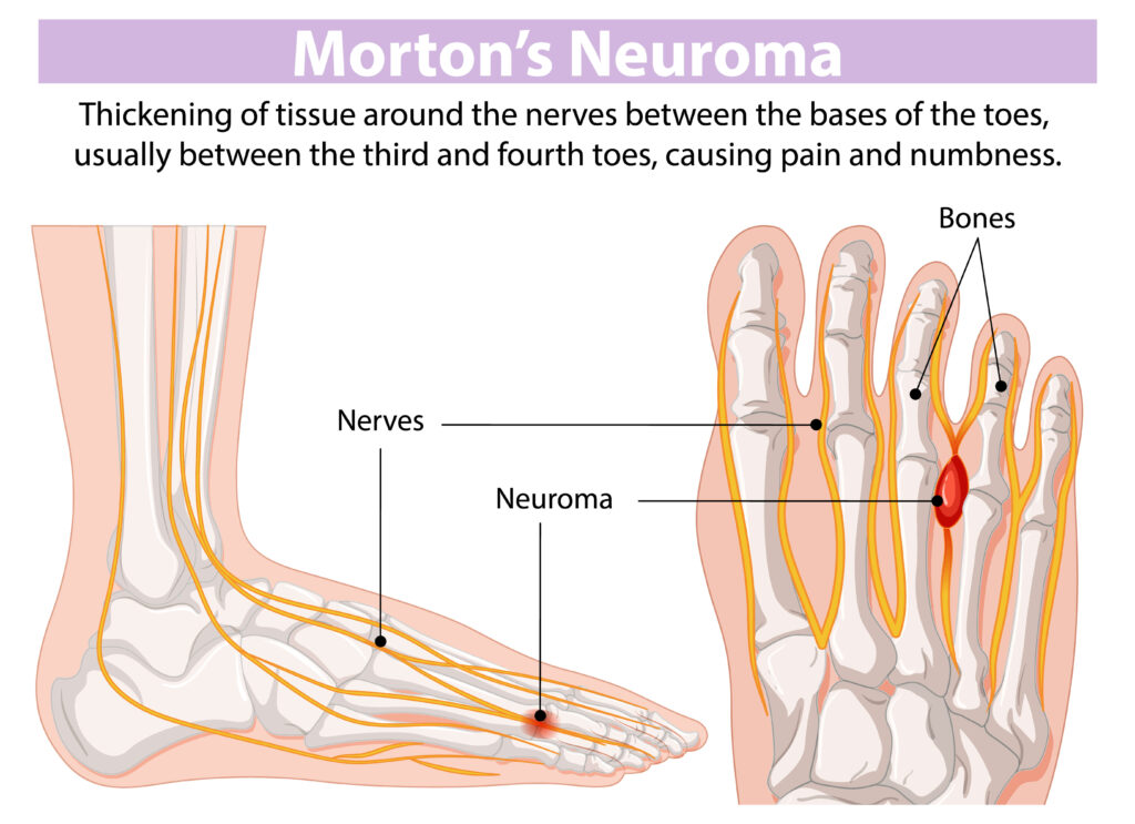 Opération du névrome de Morton ratée : pourquoi ai-je encore mal ? 7 Schéma du pied montrant un névrome de Morton (boule nerveuse) entre deux métatarses, avec une zone de douleur persistante.