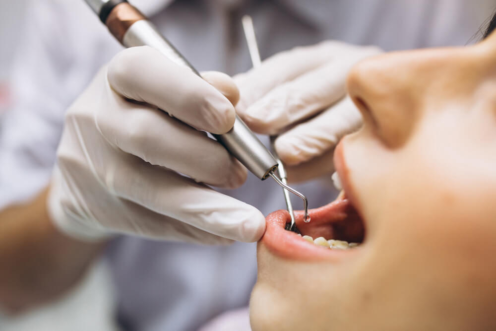 Recoller une dent avec de la Super Glue : est-ce une bonne idée ? 3
