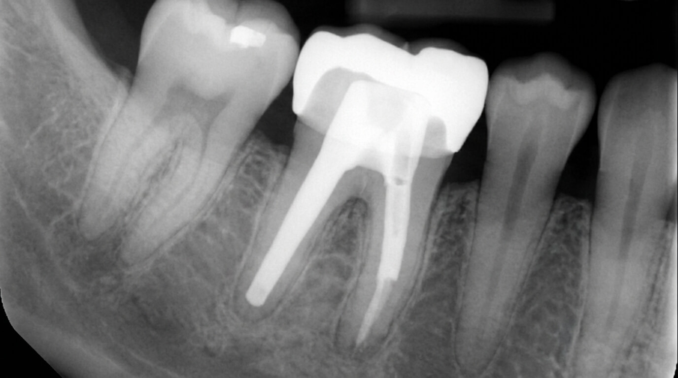 Radiographie dentaire montrant une ancienne couronne Richmond avec un tenon métallique monobloc inséré dans la racine