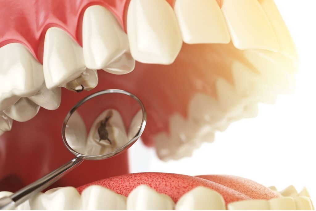 Caries dentaires : comprendre, prévenir et soigner efficacement 2