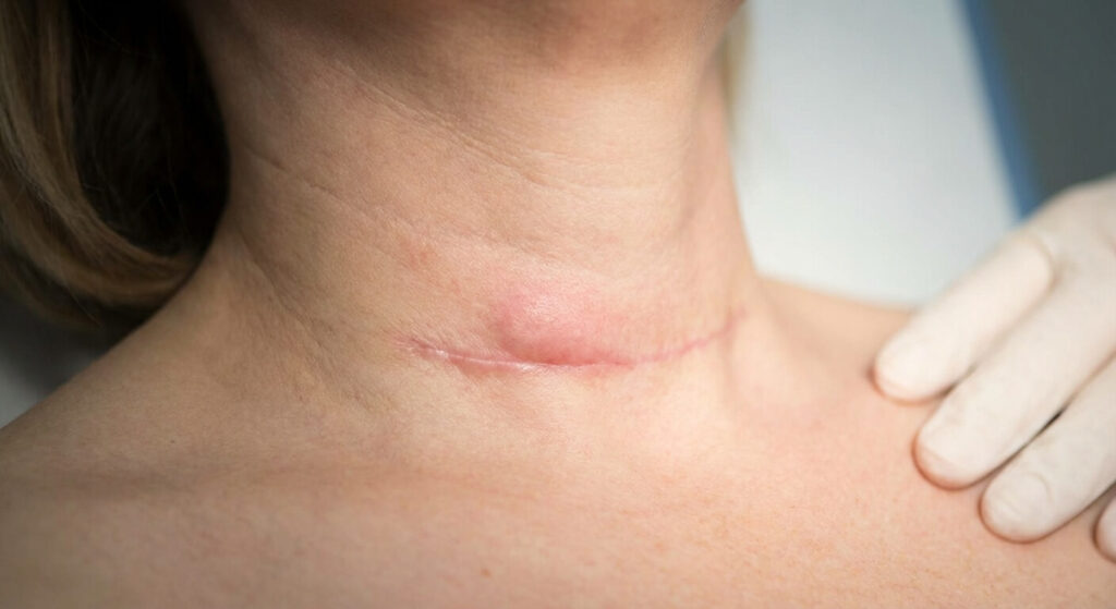 Cou d'un patient présentant un léger œdème inflammatoire sous forme de bourrelet au-dessus de la cicatrice de thyroïdectomie