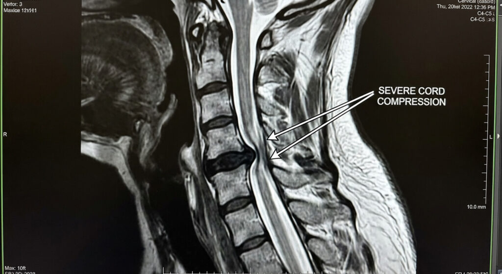 Coupe IRM de la colonne vertébrale montrant une compression sévère de la moelle épinière au niveau des cervicales