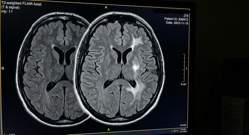 Hypersignal T2 inflammatoire à l'IRM : Comprendre votre compte-rendu 2 Coupe transversale d'une IRM cérébrale révélant une tache blanche caractéristique d'un hypersignal T2