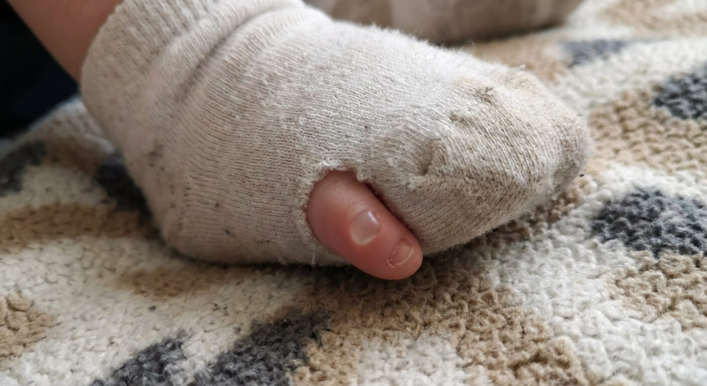 Gros plan sur une cloque de frottement sur le petit orteil d'un bébé qui apprend à ramper