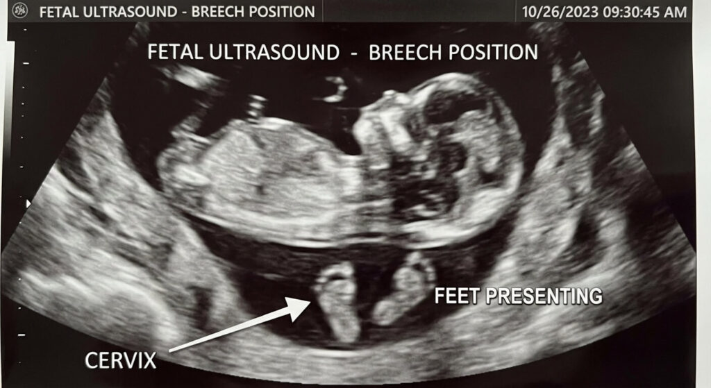 Échographie fœtale illustrant un bébé en position de siège dont les pieds pointent directement vers le col utérin