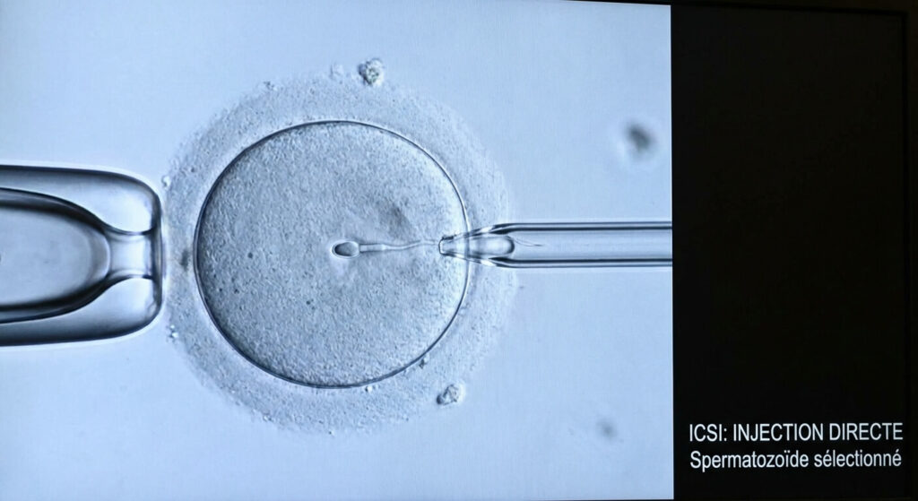Les spermatozoïdes atypiques peuvent-ils féconder un ovule ? 3 Injection intra-cytoplasmique (ICSI) d'un spermatozoïde morphologiquement sélectionné directement dans l'ovocyte