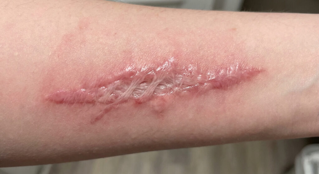 Gros plan sur une cicatrice en cours de remodelage avec présence de tissus fibreux