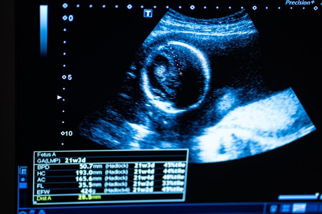 Gros plan sur l'écran d'un échographe affichant les mesures précises d'un sac gestationnel de début de grossess