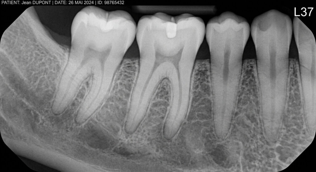 Poser une couronne sur une dent vivante : avis, avantages et risques 4 Une radiographie de contrôle montrant la racine saine et vivante d'une dent avant un soin prothétique.