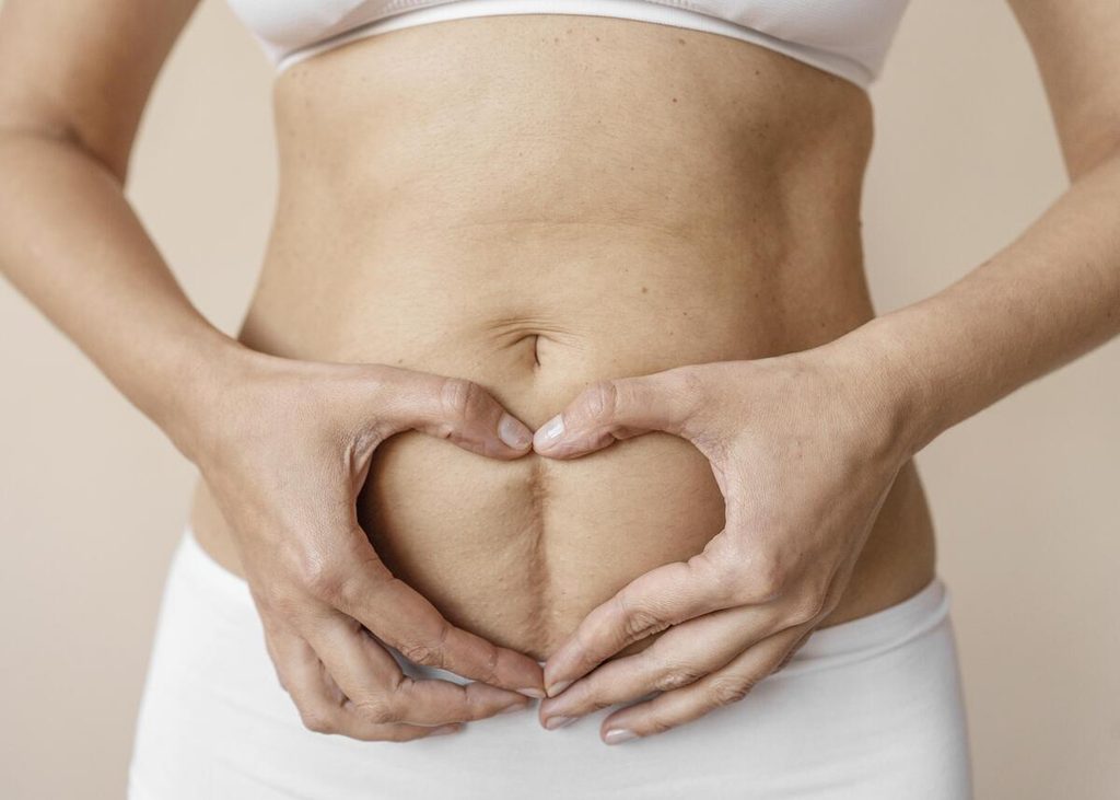Enlever les agrafes de césarienne : la douleur à quoi s'attendre 3 Cicatrice de césarienne nette et refermée avec bandes adhésives Stéri-Strip de renfort.