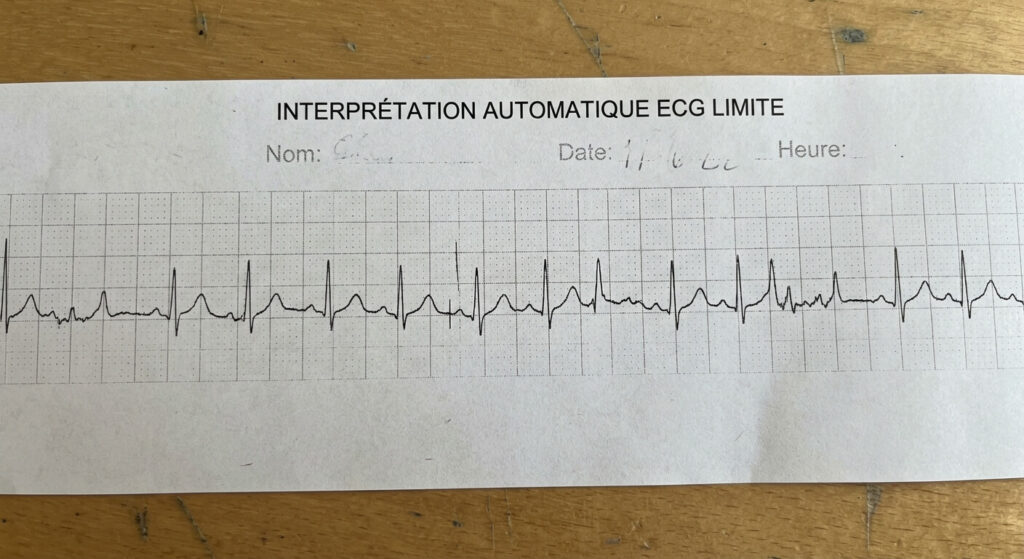 Impression papier d'un tracé d'électrocardiogramme avec la mention d'interprétation automatique ECG limite.