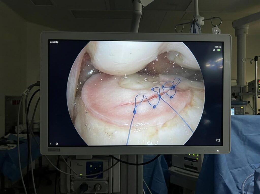 Écran d'arthroscopie montrant les points de suture posés sur la fissure d'un ménisque du genou.