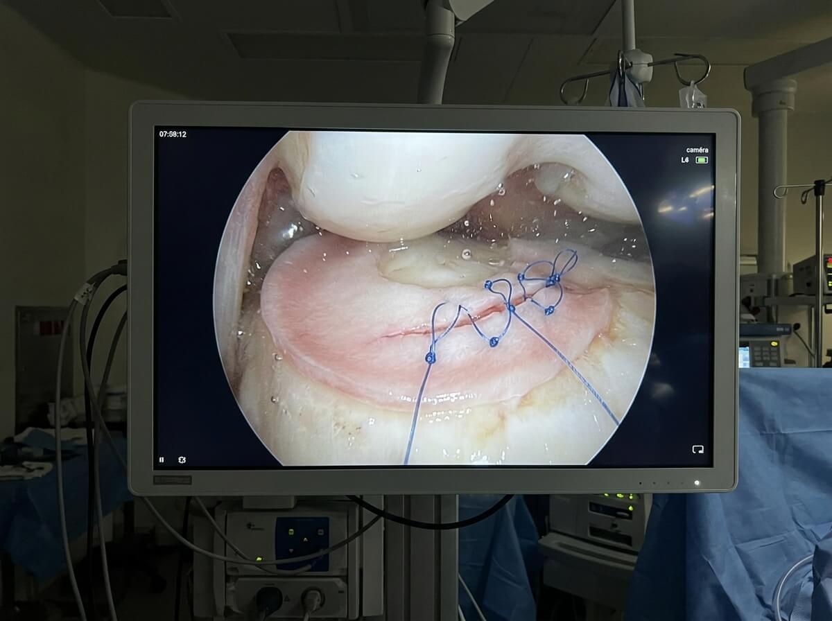Écran d'arthroscopie montrant les points de suture posés sur la fissure d'un ménisque du genou.