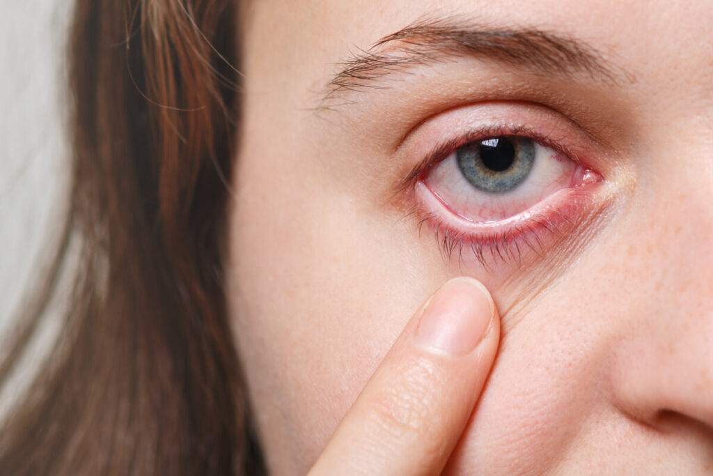 Petite boule inflammatoire rouge localisée sur la paupière supérieure d'un œil fatigué.