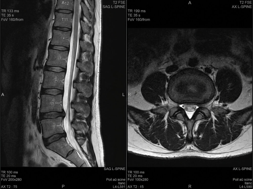 Bombement discal et arrêt de travail : durée, reprise et droits 2 Coupe IRM montrant un léger débord discal circonférentiel sans hernie exclue.