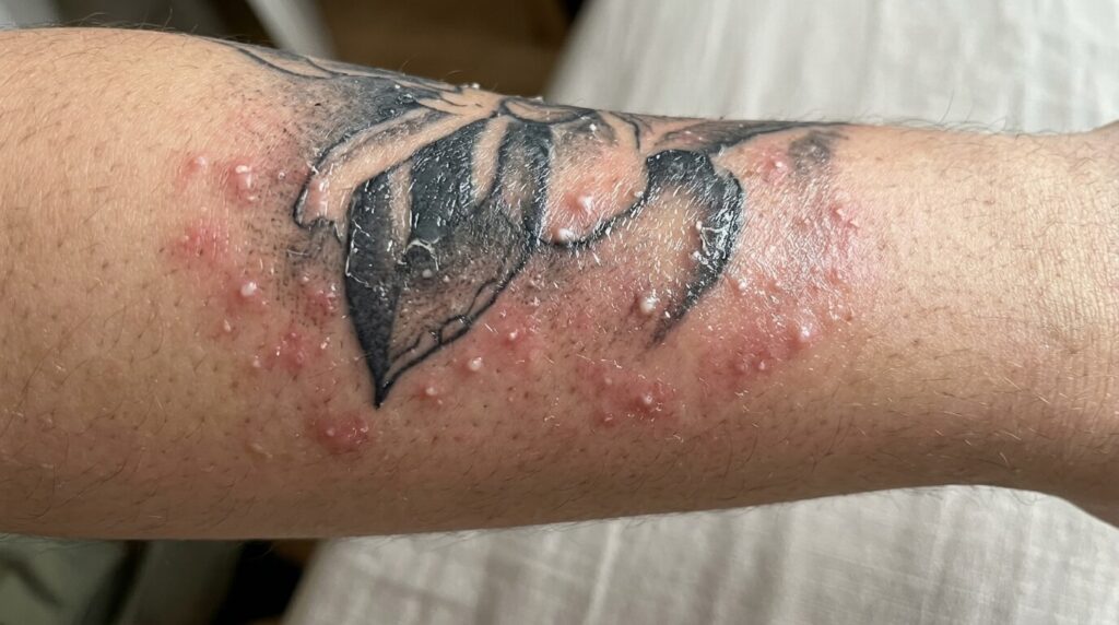 Boutons sur un tatouage : causes, erreurs de crème et solutions 2 Petits boutons blancs et rougeurs apparus sur un tatouage récent en cours de cicatrisation.