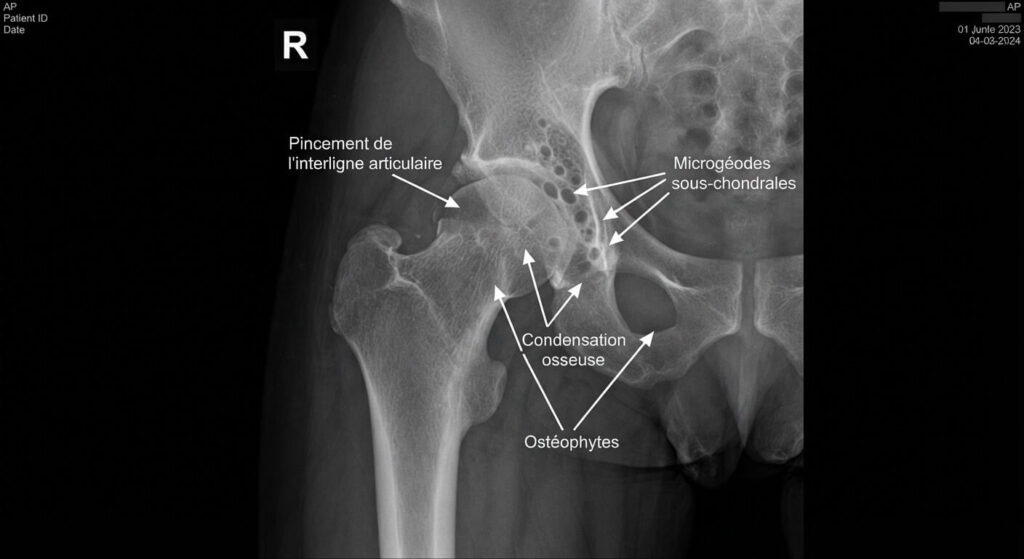 Radiographie médicale montrant des microgéodes sous-chondrales et un pincement de l'interligne articulaire.