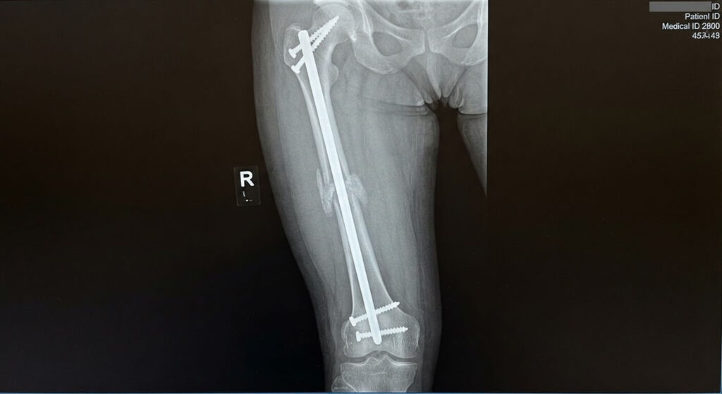Temps de consolidation d'une fracture du fémur : délais de guérison et reprise de la marche 2 Cliché radiologique montrant l'enclouage centromédullaire d'une fracture du fémur avec cal osseux en formation.