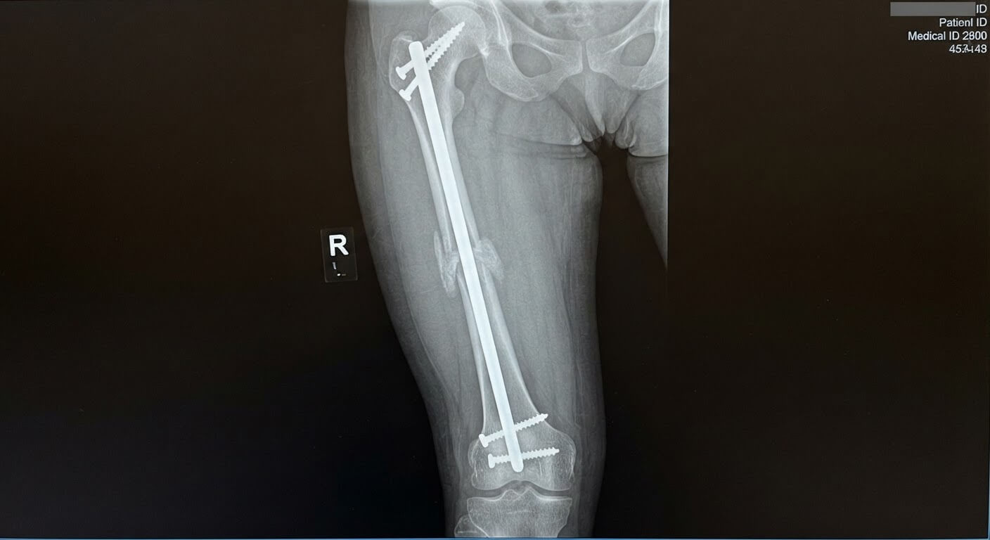 Cliché radiologique montrant l'enclouage centromédullaire d'une fracture du fémur avec cal osseux en formation.